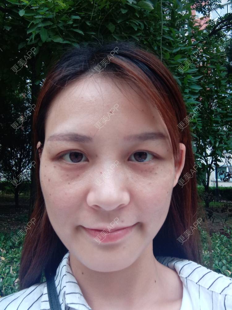 更美 - 星妹子的皮秒激光经验 | 肤质检测 | 皮秒激光 | 北京