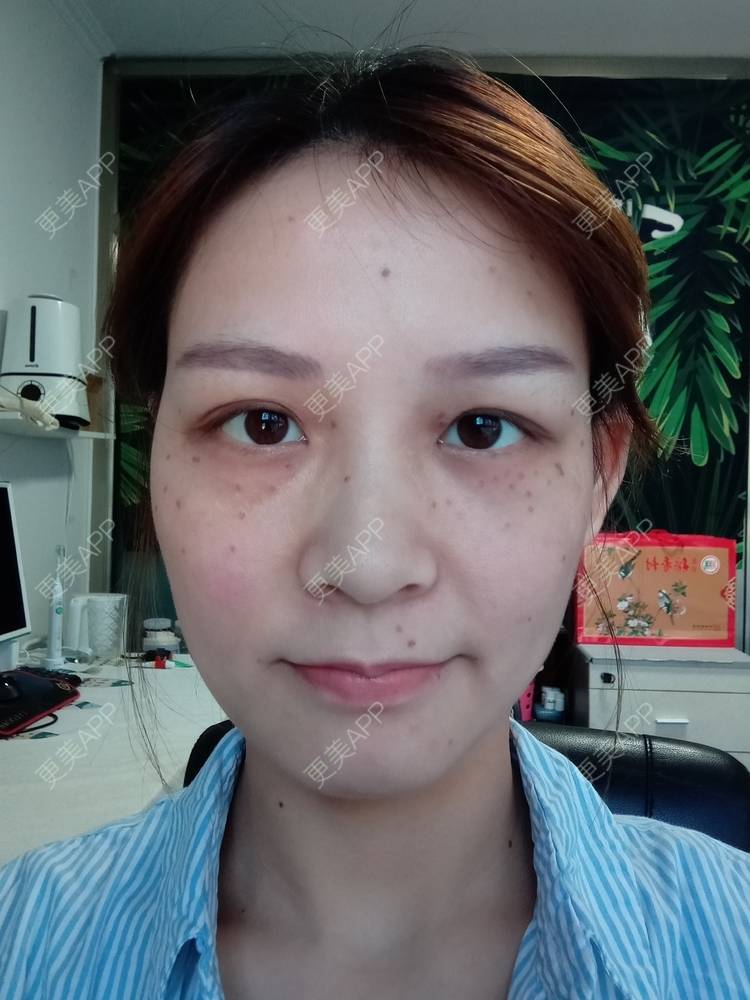 更美 - 星妹子的皮秒激光经验 | 肤质检测 | 皮秒激光 | 北京