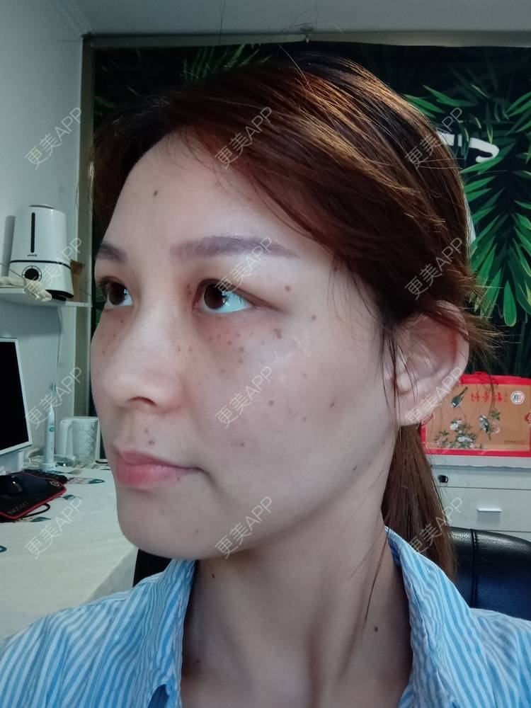 更美 - 星妹子的皮秒激光经验 | 肤质检测 | 皮秒激光 | 北京