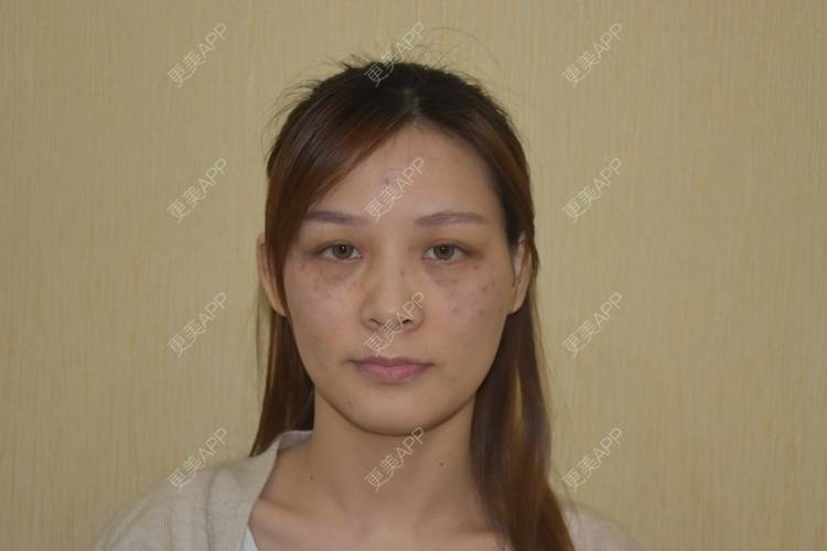 更美 - 星妹子的皮秒激光经验 | 肤质检测 | 皮秒激光 | 北京