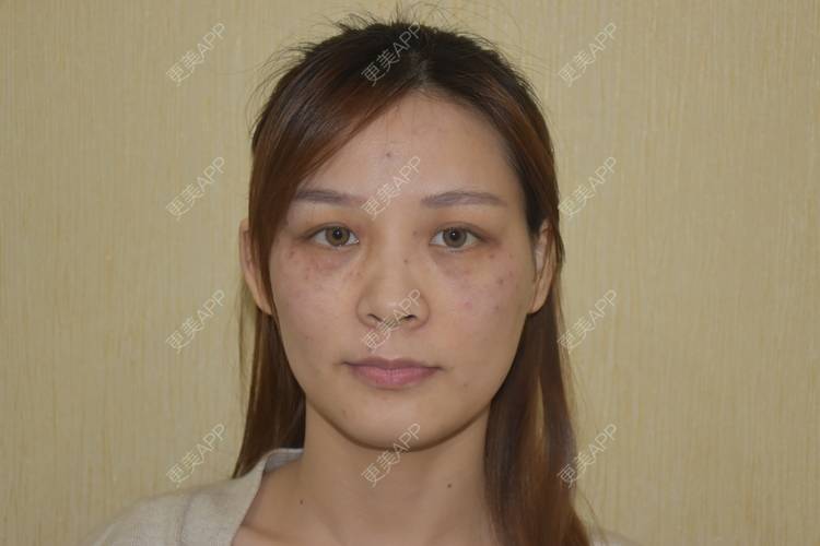 更美 - 星妹子的皮秒激光经验 | 肤质检测 | 皮秒激光 | 北京