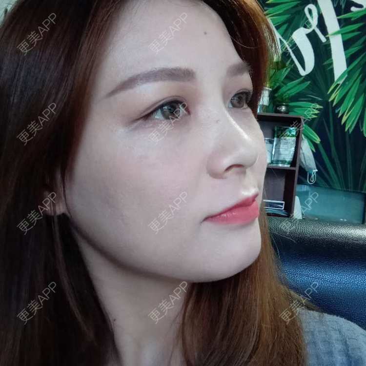 更美 - 星妹子的皮秒激光经验 | 肤质检测 | 皮秒激光 | 北京