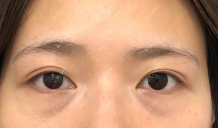 更美 - 更美用户j3kMfV9jN7的胶原蛋白淡化黑眼圈经验 | 胶原蛋白丰泪沟 | 胶原蛋白淡化黑眼圈