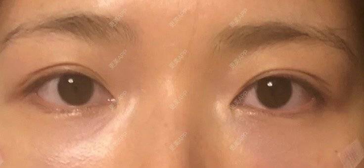 更美 - 更美用户j3kMfV9jN7的胶原蛋白淡化黑眼圈经验 | 胶原蛋白丰泪沟 | 胶原蛋白淡化黑眼圈