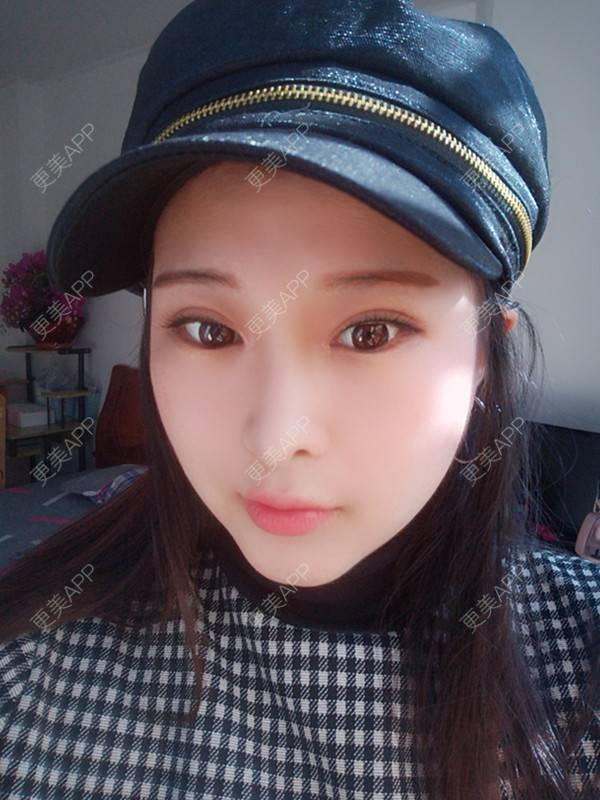 更美 - WildBoy的鼻部综合经验 | 福州 | 视频日记 | 鼻部综合