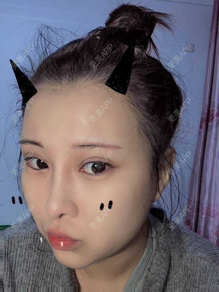 更美 - WildBoy的鼻部综合经验 | 福州 | 视频日记 | 鼻部综合