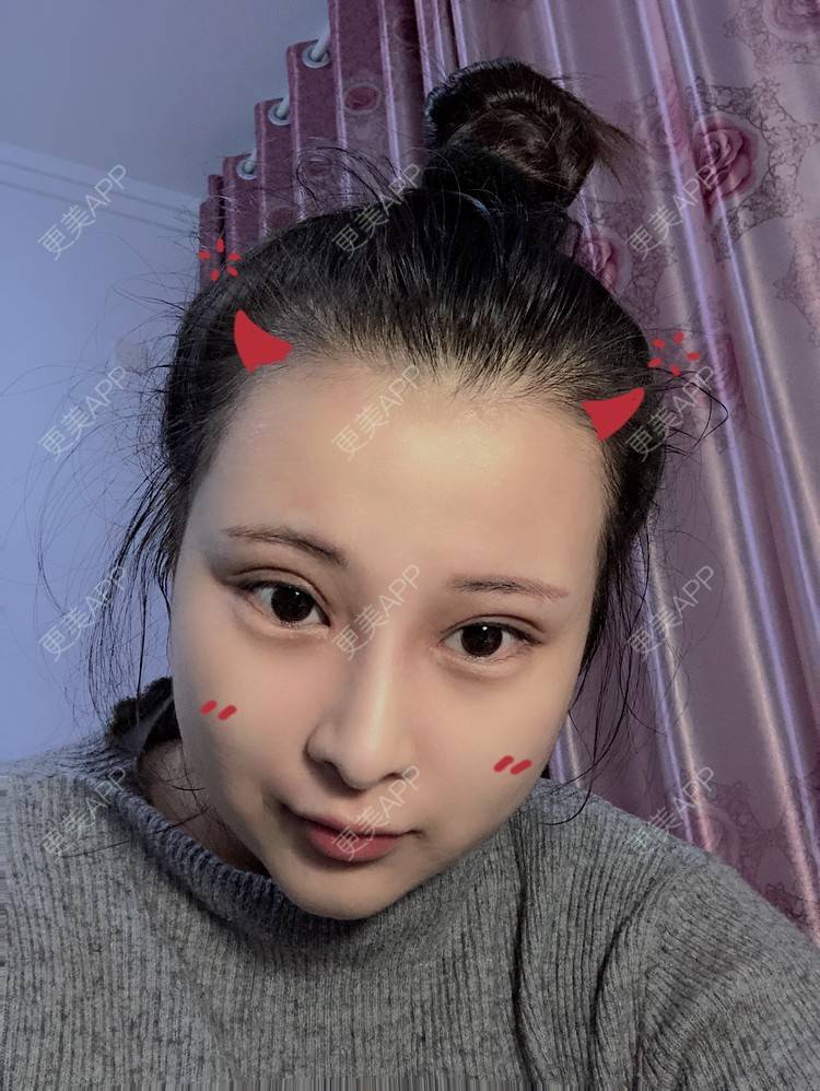 更美 - WildBoy的鼻部综合经验 | 福州 | 视频日记 | 鼻部综合