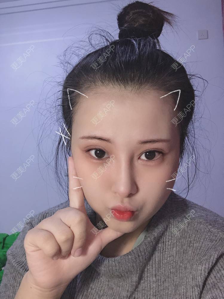 更美 - WildBoy的鼻部综合经验 | 福州 | 视频日记 | 鼻部综合