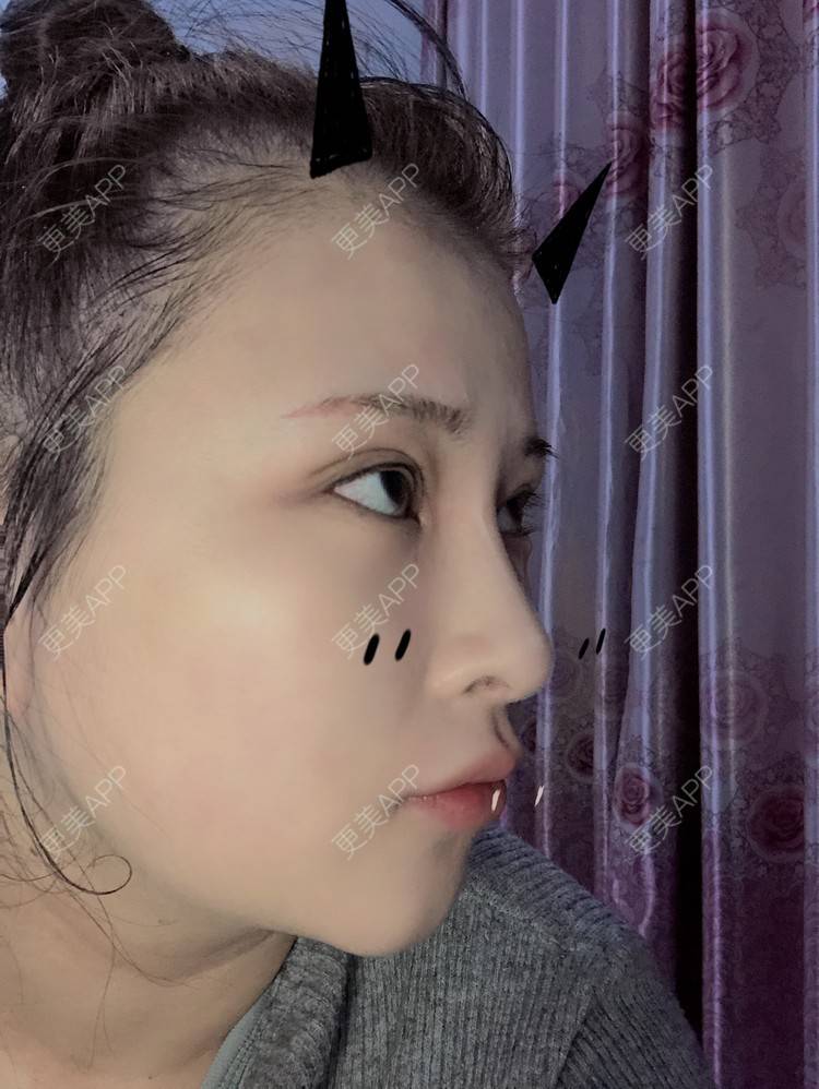 更美 - WildBoy的鼻部综合经验 | 福州 | 视频日记 | 鼻部综合