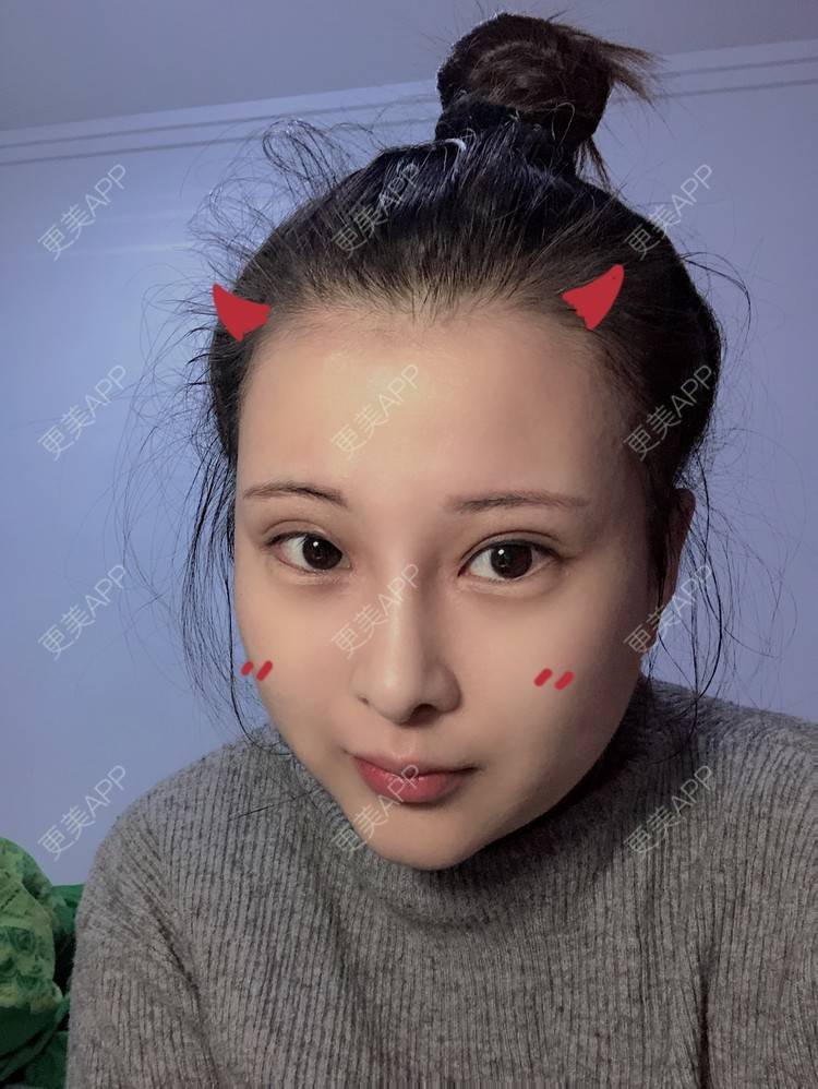 更美 - WildBoy的鼻部综合经验 | 福州 | 视频日记 | 鼻部综合