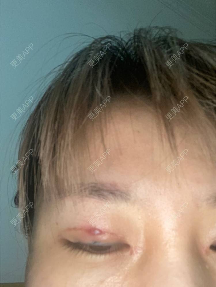 更美 - 更美用户3gp5N5Ngs7的全切双眼皮经验 | 全切双眼皮 | 武汉