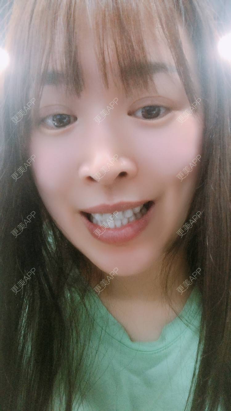 更美 - 更美用户nOSa2OXrxm的冷光美白经验 | 北京 | 冷光美白