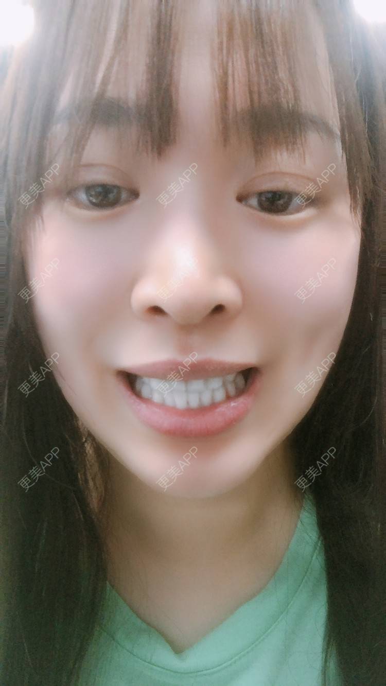 更美 - 更美用户nOSa2OXrxm的冷光美白经验 | 北京 | 冷光美白