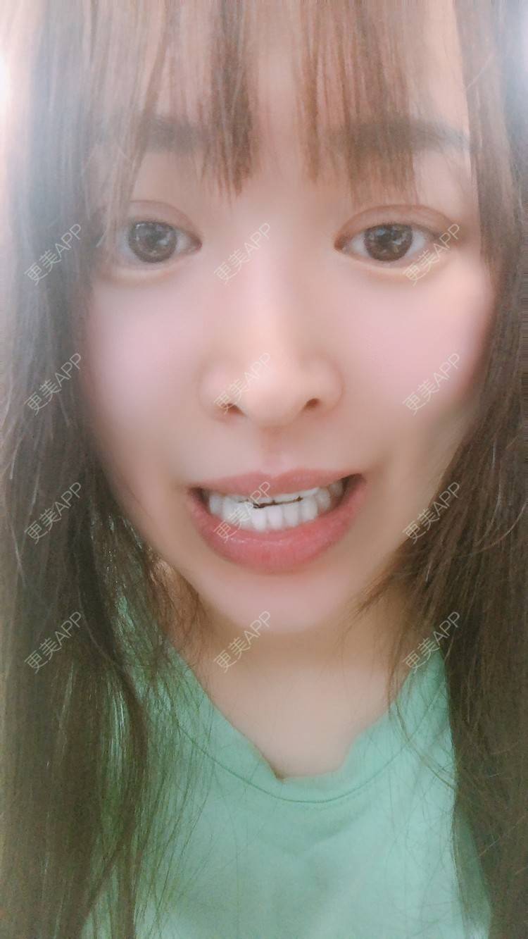 更美 - 更美用户nOSa2OXrxm的冷光美白经验 | 北京 | 冷光美白