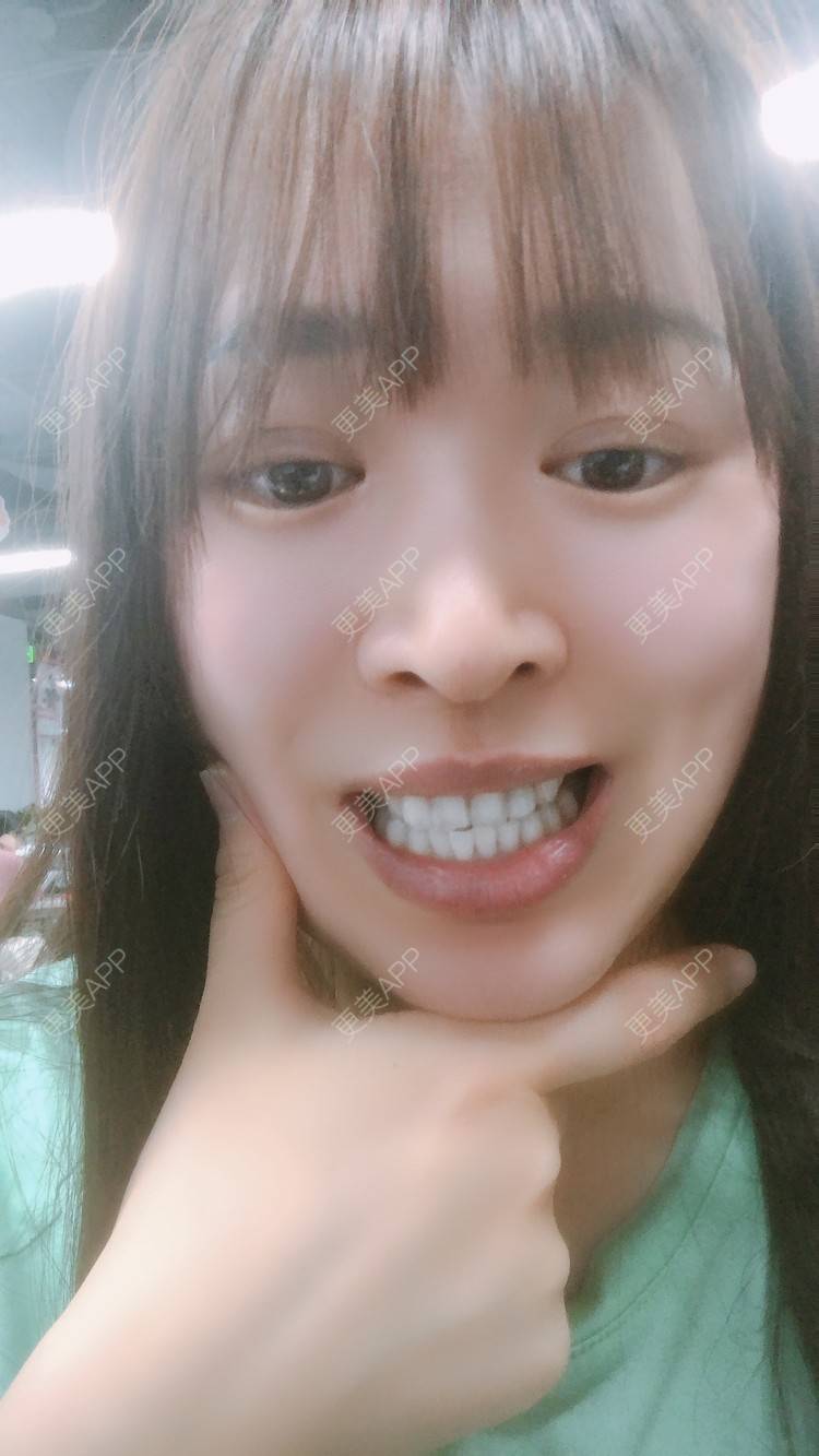 更美 - 更美用户nOSa2OXrxm的冷光美白经验 | 北京 | 冷光美白
