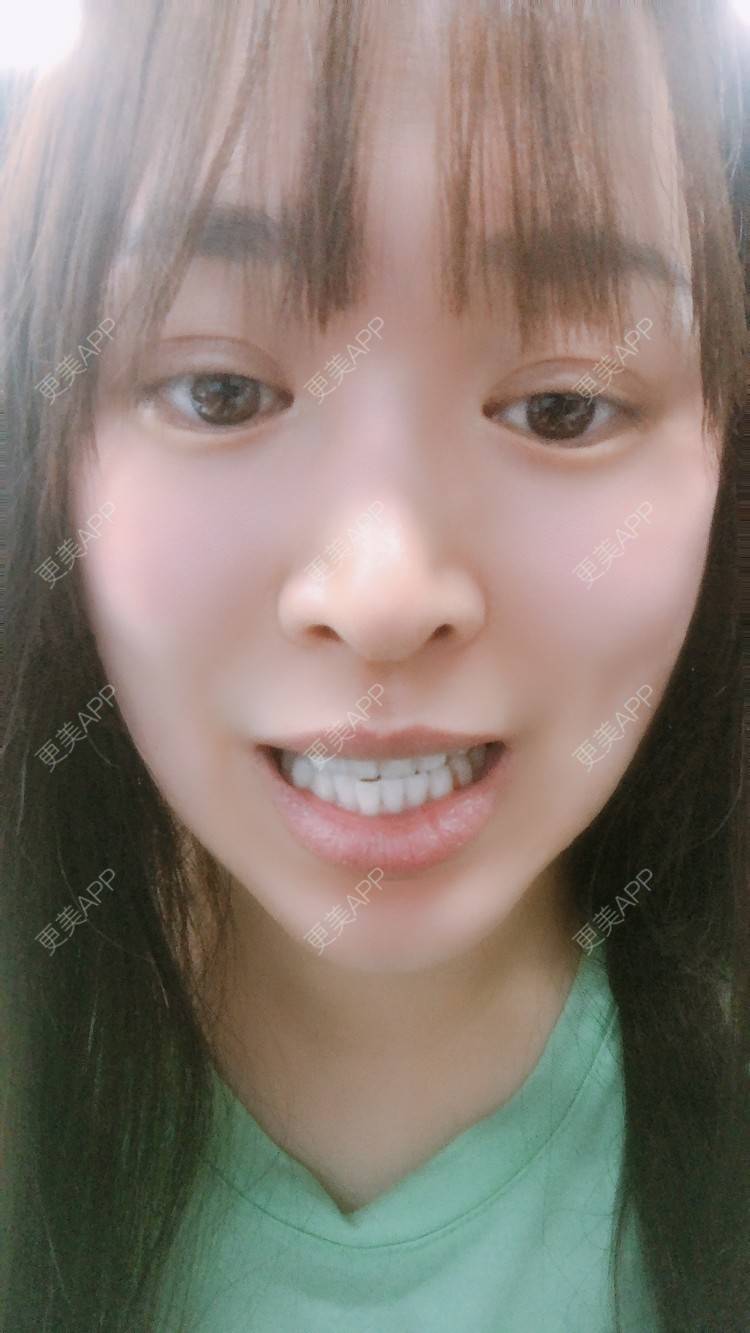 更美 - 更美用户nOSa2OXrxm的冷光美白经验 | 北京 | 冷光美白
