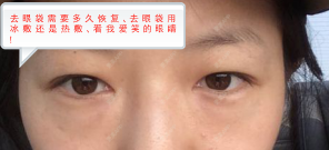 更美 - 迎颩菈屎卟艜紙茄的外切去眼袋经验 | 北京 | 外切去眼袋