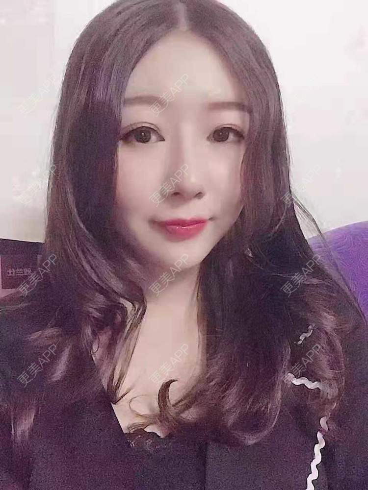 更美 - 更美用户oddCuSyrcj的鼻部多项经验 | 广州 | 鼻部多项