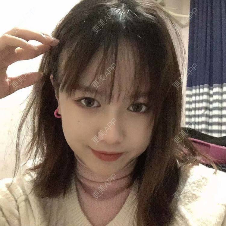 更美 - 小雨小鱼小玉的定点双眼皮经验 | 成都 | 视频日记 | 全切双眼皮 | 定点双眼皮