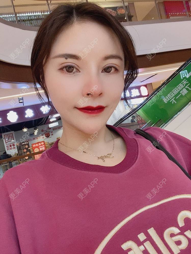 更美 - 更美用户cYoCneHuFl的鼻部多项经验 | 阳江 | 鼻部多项