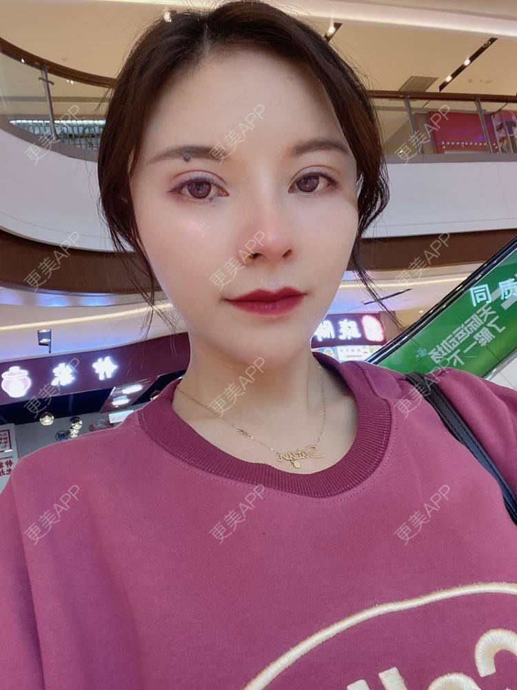 更美 - 更美用户cYoCneHuFl的鼻部多项经验 | 阳江 | 鼻部多项
