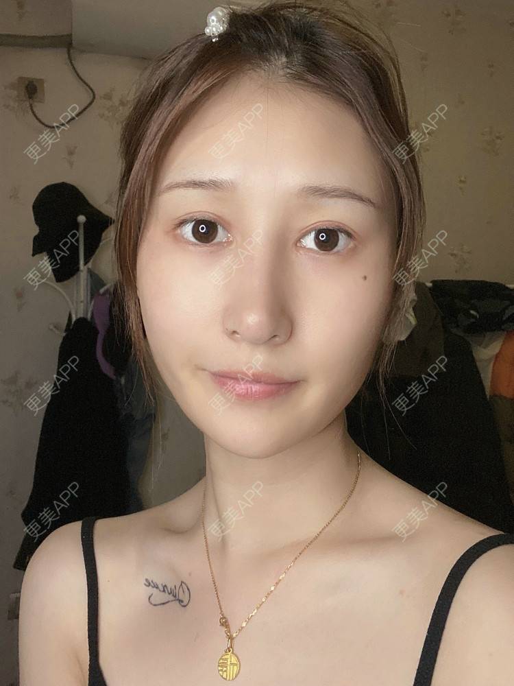 更美 - 真心已售完谝的定点双眼皮经验 | 北京 | 定点双眼皮