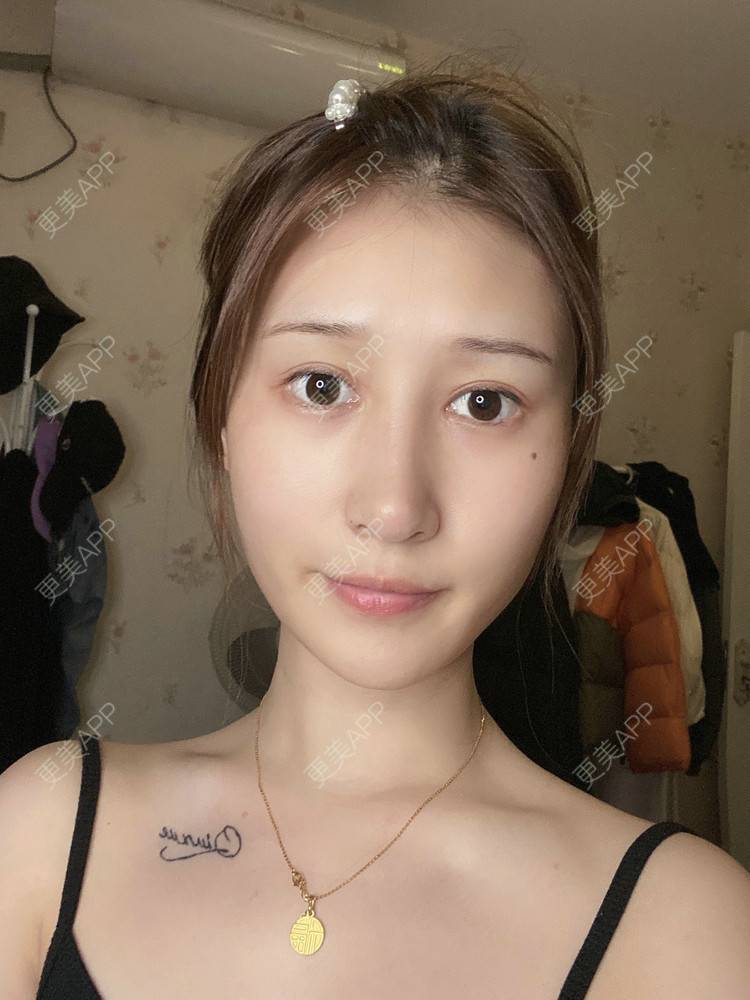 更美 - 真心已售完谝的定点双眼皮经验 | 北京 | 定点双眼皮