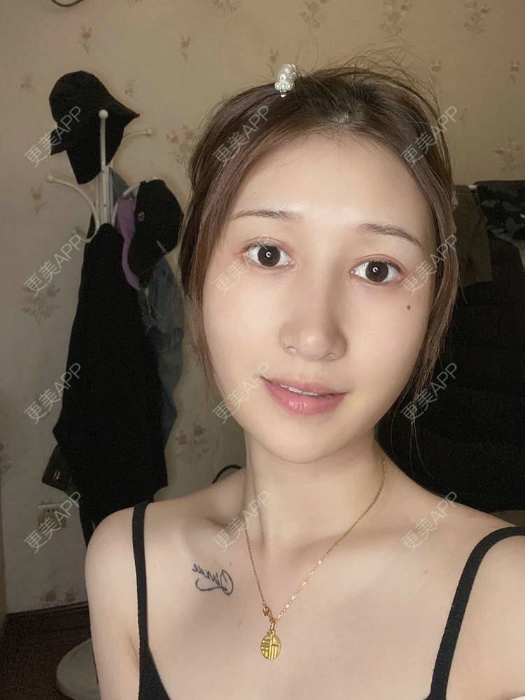 更美 - 真心已售完谝的定点双眼皮经验 | 北京 | 定点双眼皮