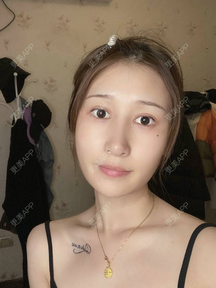 更美 - 真心已售完谝的定点双眼皮经验 | 北京 | 定点双眼皮