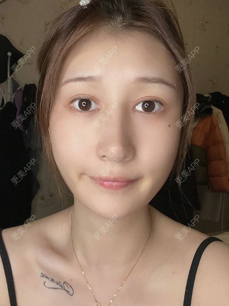 更美 - 真心已售完谝的定点双眼皮经验 | 北京 | 定点双眼皮