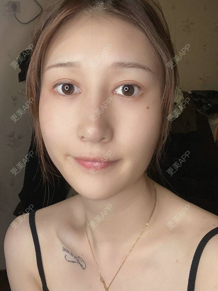 更美 - 真心已售完谝的定点双眼皮经验 | 北京 | 定点双眼皮