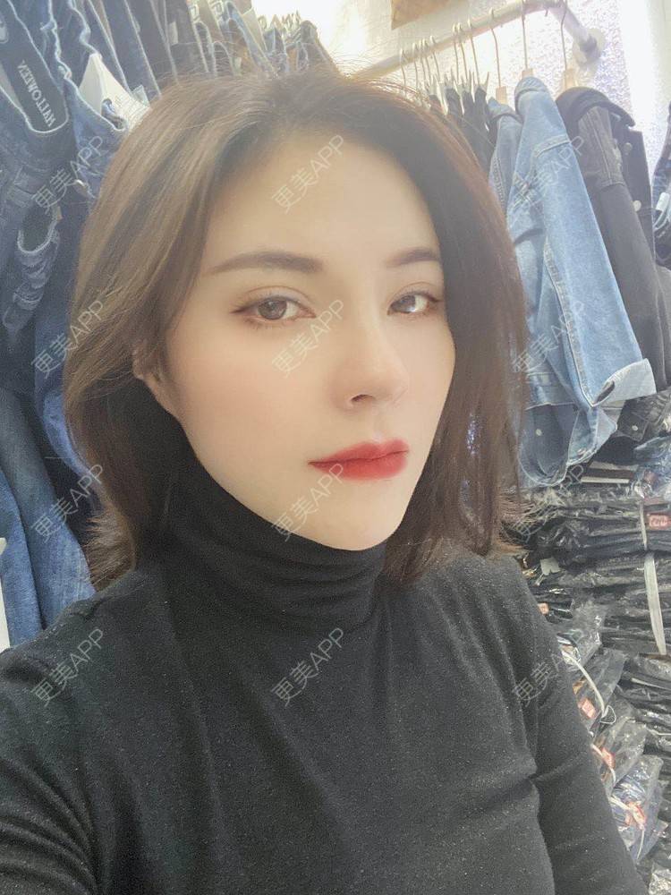 更美 - 更美用户cYoCneHuFl的鼻部多项经验 | 阳江 | 鼻部多项