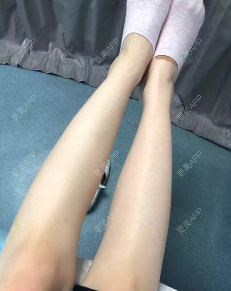 更美 - 更美用户6a9y6J9GxJ的大腿脱毛经验 | 大腿脱毛