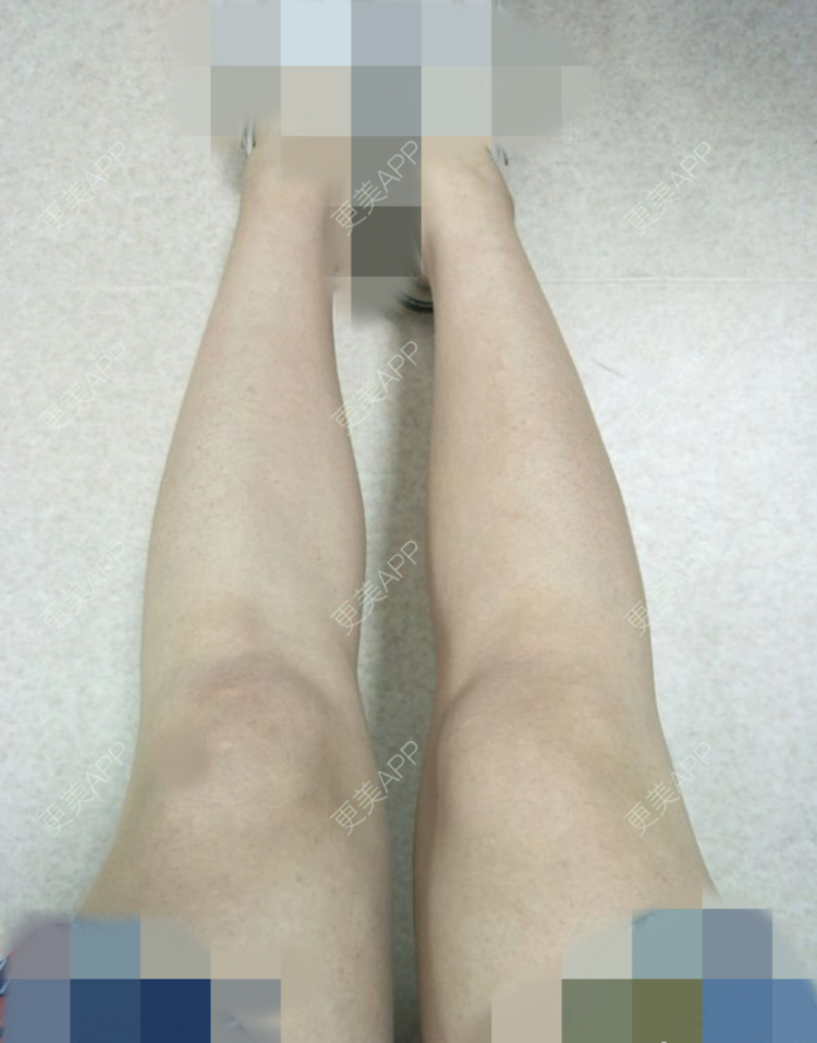 更美 - 更美用户E9WhfA5Cnr的大腿脱毛经验 | 大腿脱毛