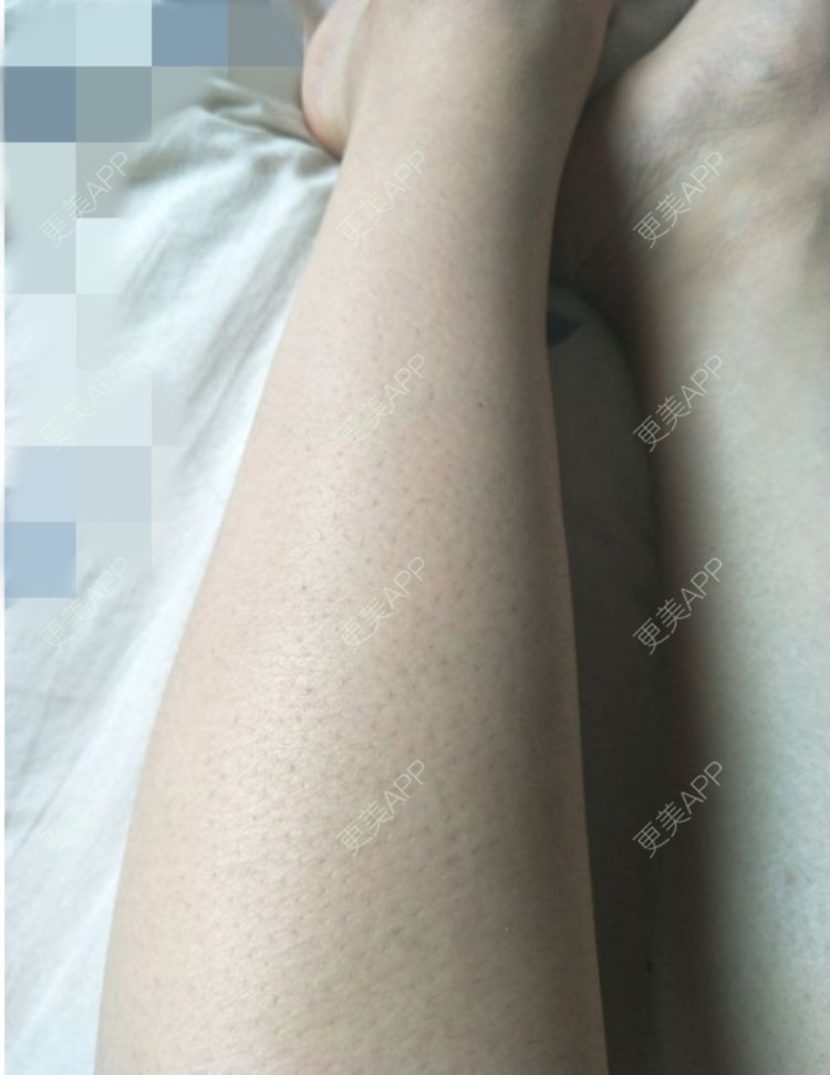更美 - 更美用户E9WhfA5Cnr的大腿脱毛经验 | 大腿脱毛