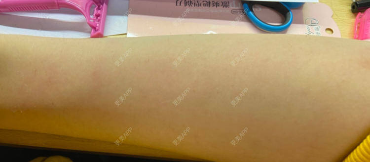 更美 - 更美用户sPEtL6guHL的手臂脱毛经验 | 手臂脱毛
