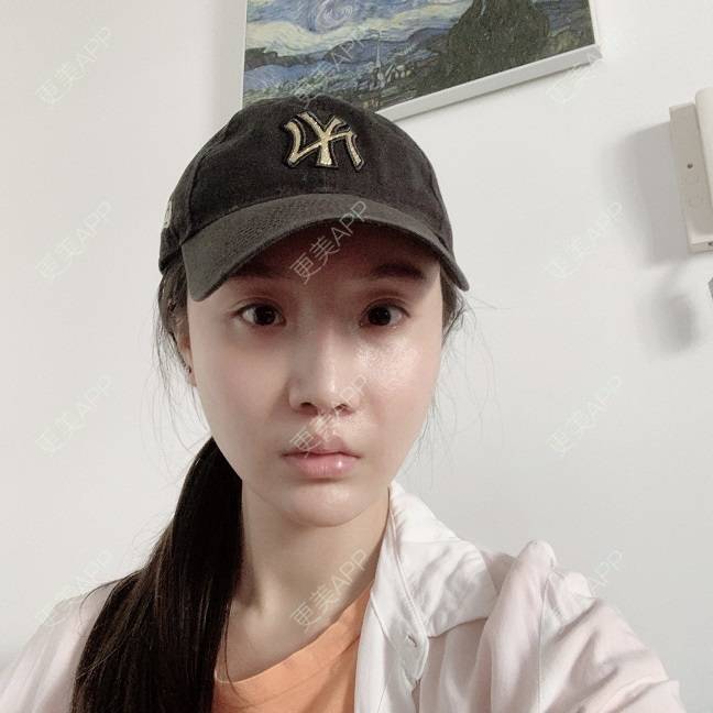 更美 - 更美用户DLi7HL09O1的人中缩短经验 | 人中缩短 | 广州