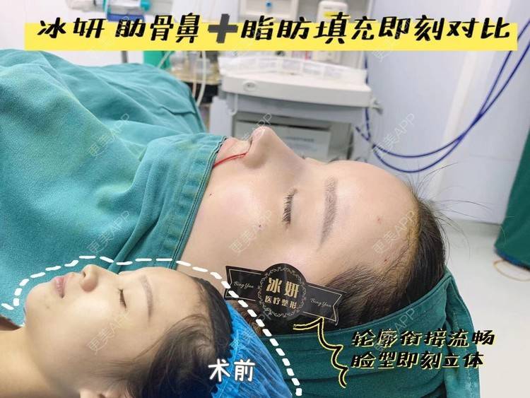 更美 - 祢的美丽/我的职责的鼻部多项经验 | 自体脂肪全面部填充 | 鼻部多项 | 上海