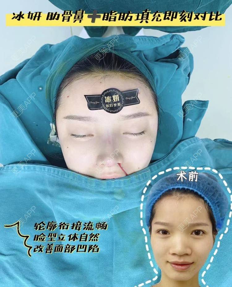 更美 - 祢的美丽/我的职责的鼻部多项经验 | 自体脂肪全面部填充 | 鼻部多项 | 上海