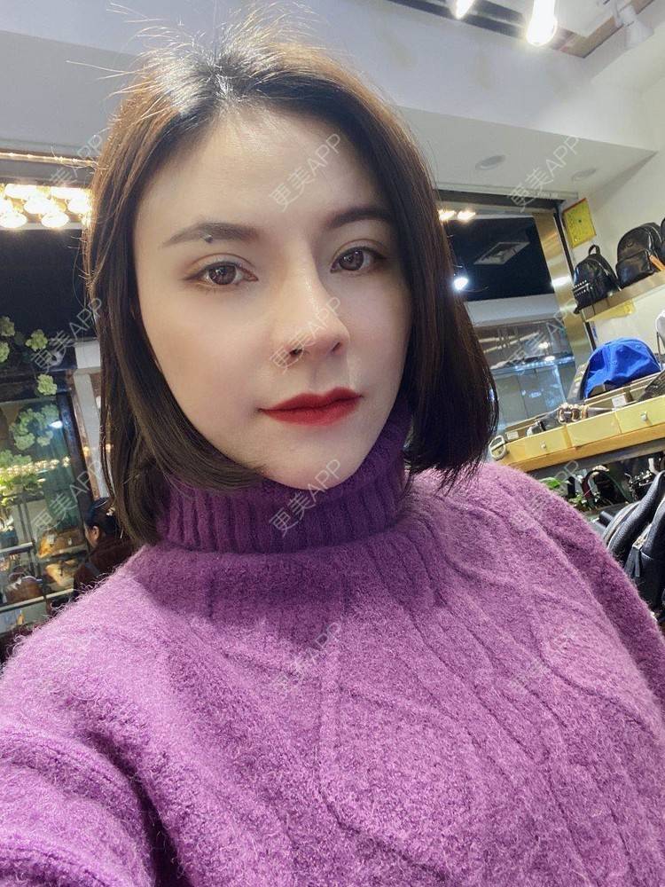 更美 - 更美用户cYoCneHuFl的鼻部多项经验 | 阳江 | 鼻部多项