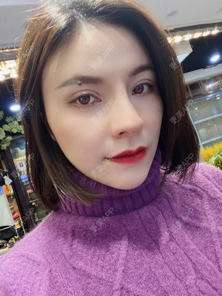 更美 - 更美用户cYoCneHuFl的鼻部多项经验 | 阳江 | 鼻部多项