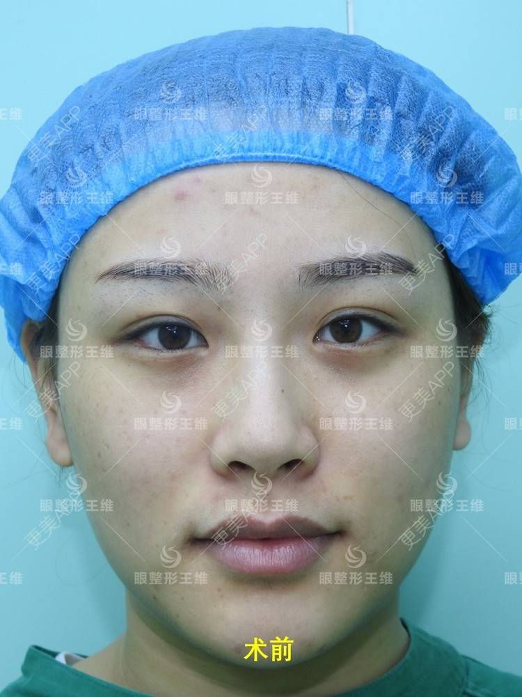 更美 - 凡凡的日常的双眼皮修复经验 | 双眼皮修复 | 北京