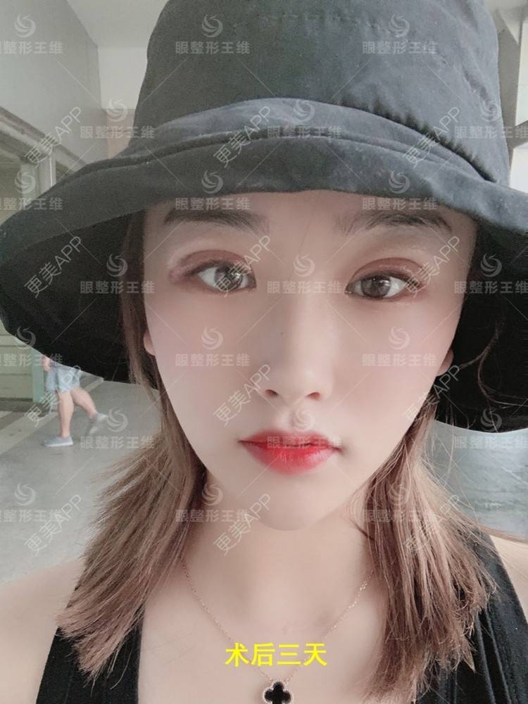 更美 - 凡凡的日常的双眼皮修复经验 | 双眼皮修复 | 北京