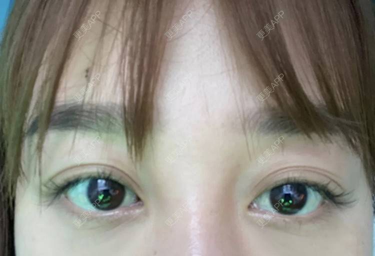 更美 - 更美用户1u0hFQY17Z的胶原蛋白丰泪沟经验 | 胶原蛋白丰泪沟