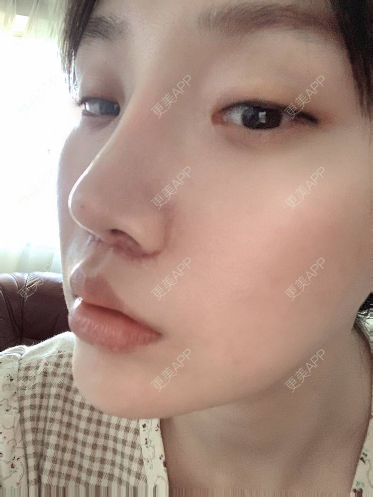 更美 - 更美用户DLi7HL09O1的人中缩短经验 | 人中缩短 | 广州