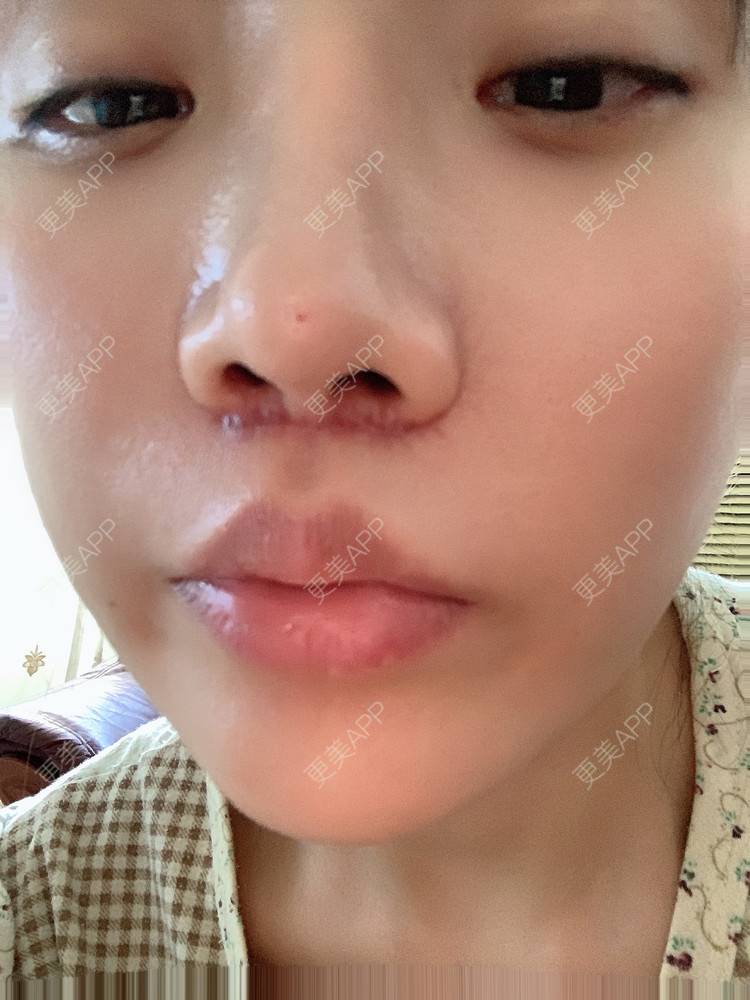 更美 - 更美用户DLi7HL09O1的人中缩短经验 | 人中缩短 | 广州