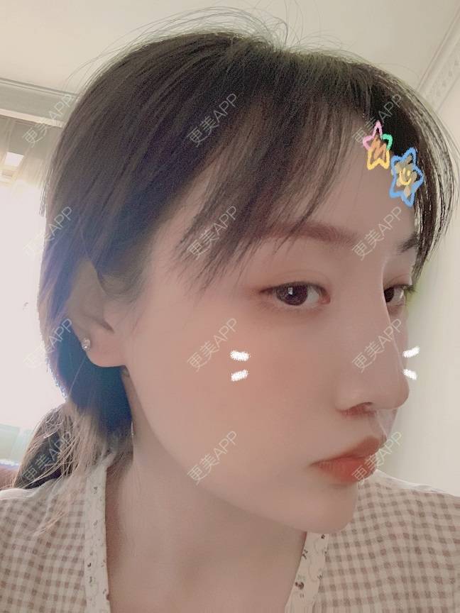 更美 - 更美用户DLi7HL09O1的人中缩短经验 | 人中缩短 | 广州