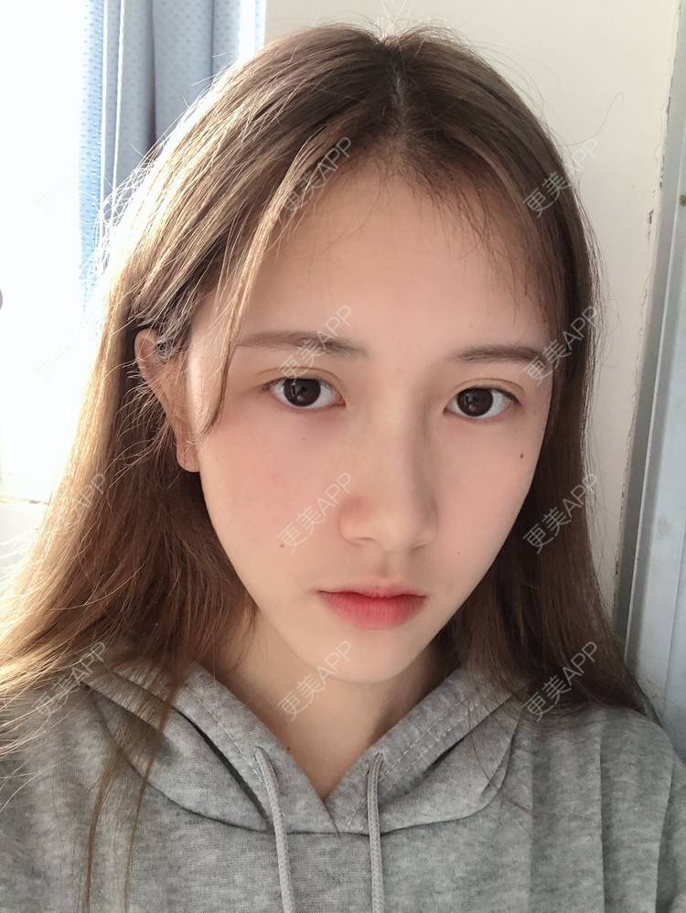 更美 - 更美用户ezaery6fSs的眼部多项经验 | 眼部多项 | 广州 | 视频日记