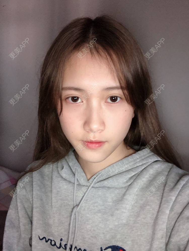 更美 - 更美用户ezaery6fSs的眼部多项经验 | 眼部多项 | 广州 | 视频日记