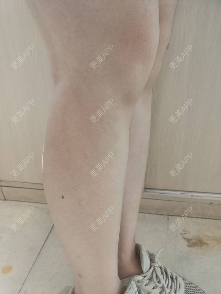 更美 - 更美用户ULBdsFURSw的手臂脱毛经验 | 广州 | 视频日记 | 手臂脱毛